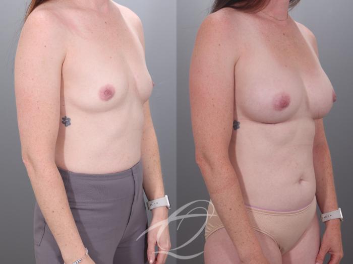 Breast Augmentation Case 1002028 Before & After Right Oblique | Serving Rochester, Syracuse & Buffalo, NY | Quatela Center for Plastic Surgery