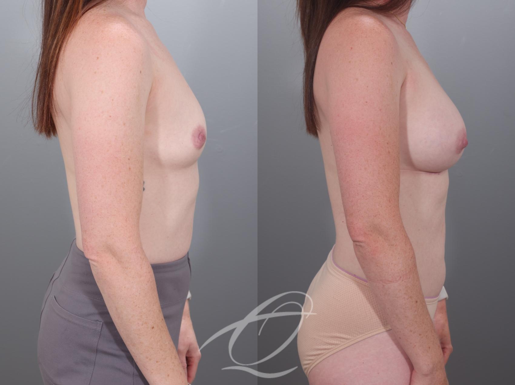 Breast Augmentation Case 1002028 Before & After Right Side | Serving Rochester, Syracuse & Buffalo, NY | Quatela Center for Plastic Surgery
