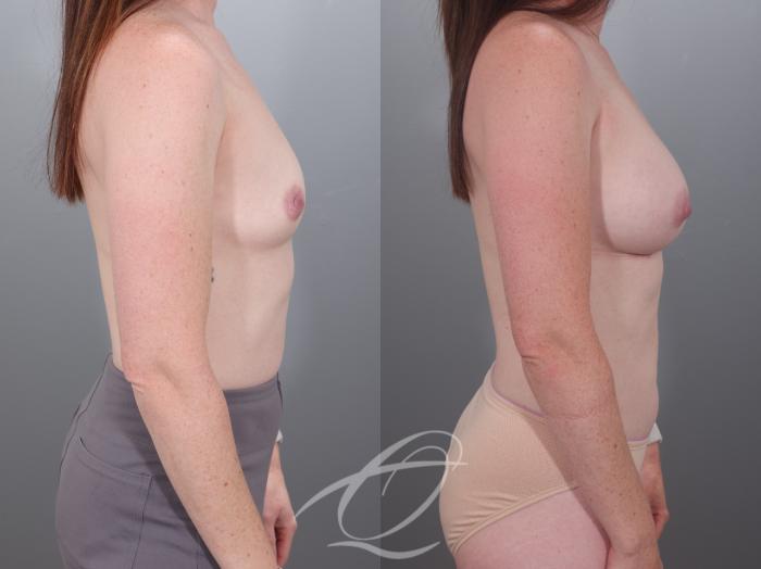 Breast Augmentation Case 1002028 Before & After Right Side | Serving Rochester, Syracuse & Buffalo, NY | Quatela Center for Plastic Surgery