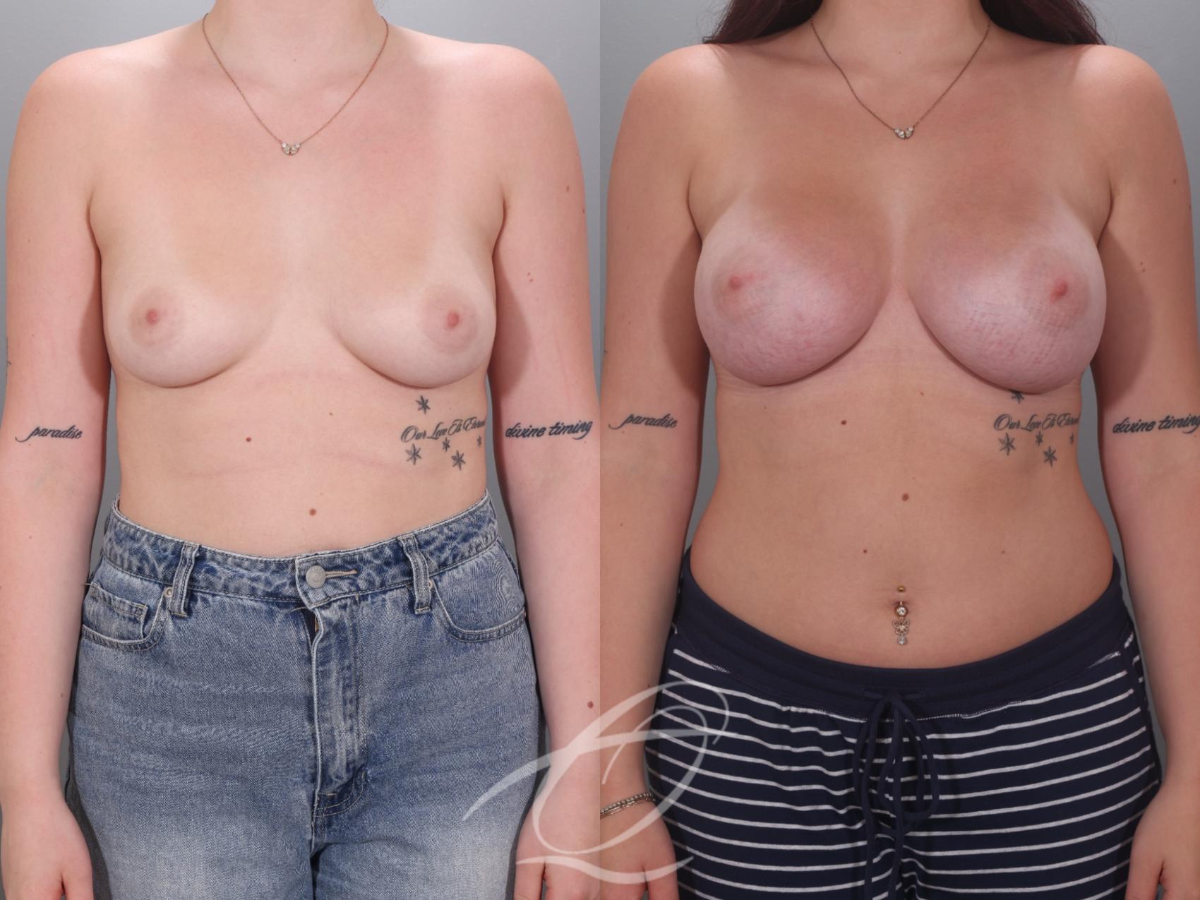 Breast Augmentation Case 1002036 Before & After Front | Serving Rochester, Syracuse & Buffalo, NY | Quatela Center for Plastic Surgery