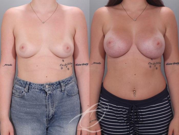 Breast Augmentation Case 1002036 Before & After Front | Serving Rochester, Syracuse & Buffalo, NY | Quatela Center for Plastic Surgery