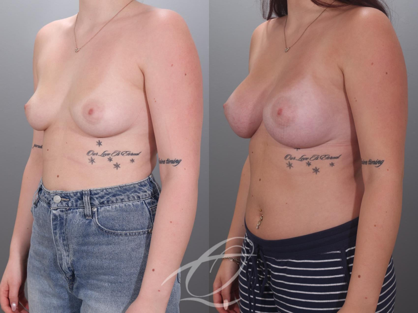 Breast Augmentation Case 1002036 Before & After Left Oblique | Serving Rochester, Syracuse & Buffalo, NY | Quatela Center for Plastic Surgery