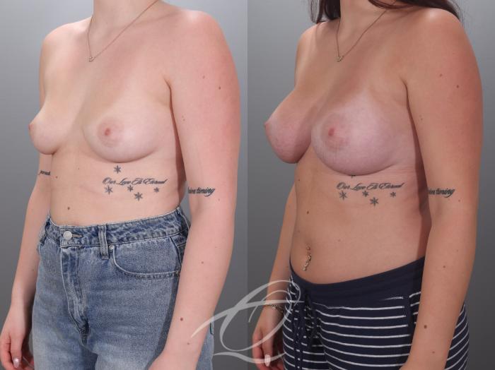 Breast Augmentation Case 1002036 Before & After Left Oblique | Serving Rochester, Syracuse & Buffalo, NY | Quatela Center for Plastic Surgery