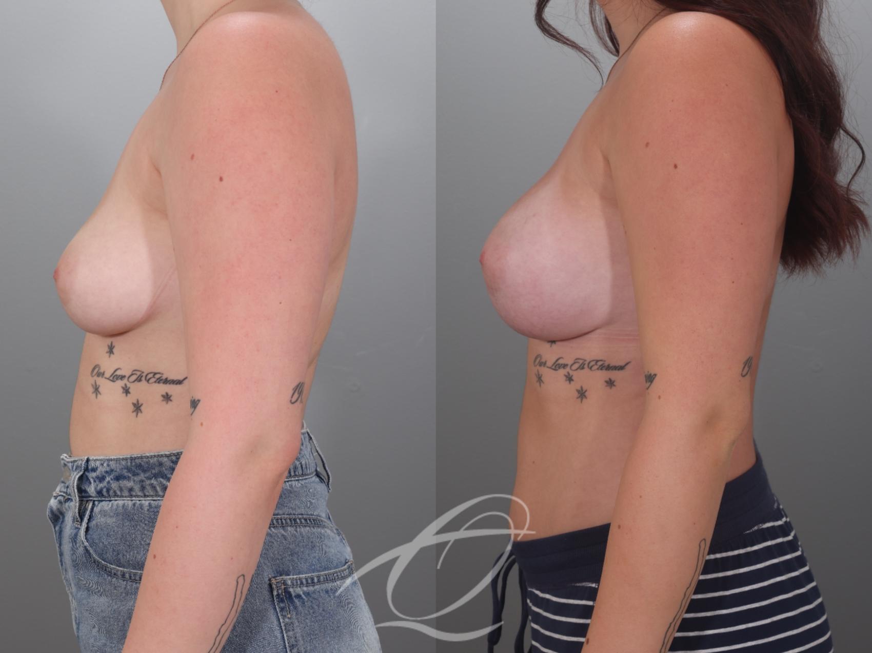 Breast Augmentation Case 1002036 Before & After Left Side | Serving Rochester, Syracuse & Buffalo, NY | Quatela Center for Plastic Surgery