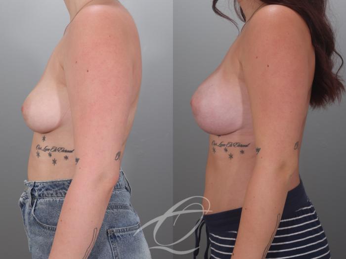 Breast Augmentation Case 1002036 Before & After Left Side | Serving Rochester, Syracuse & Buffalo, NY | Quatela Center for Plastic Surgery
