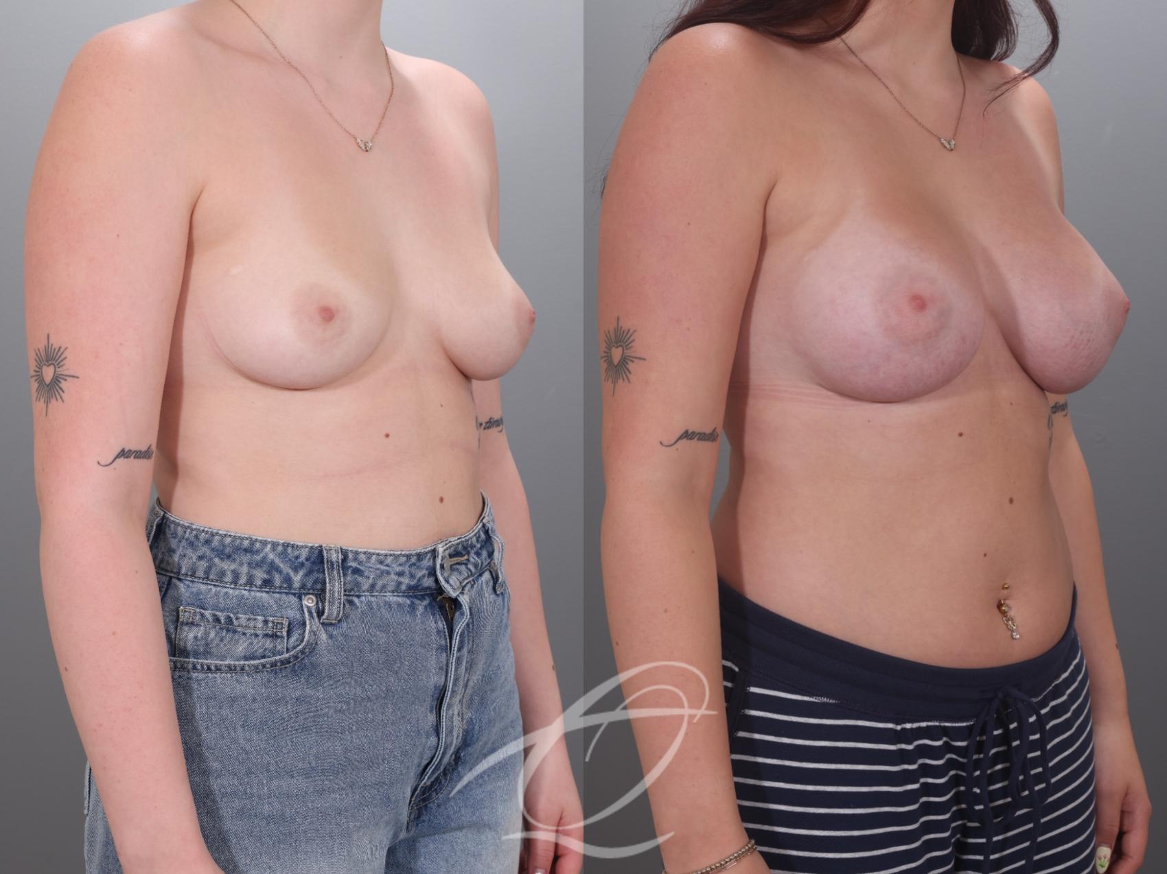 Breast Augmentation Case 1002036 Before & After Right Oblique | Serving Rochester, Syracuse & Buffalo, NY | Quatela Center for Plastic Surgery