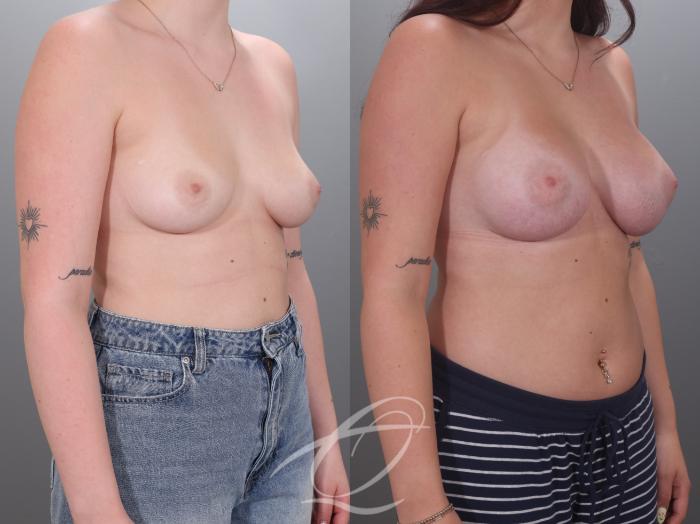 Breast Augmentation Case 1002036 Before & After Right Oblique | Serving Rochester, Syracuse & Buffalo, NY | Quatela Center for Plastic Surgery
