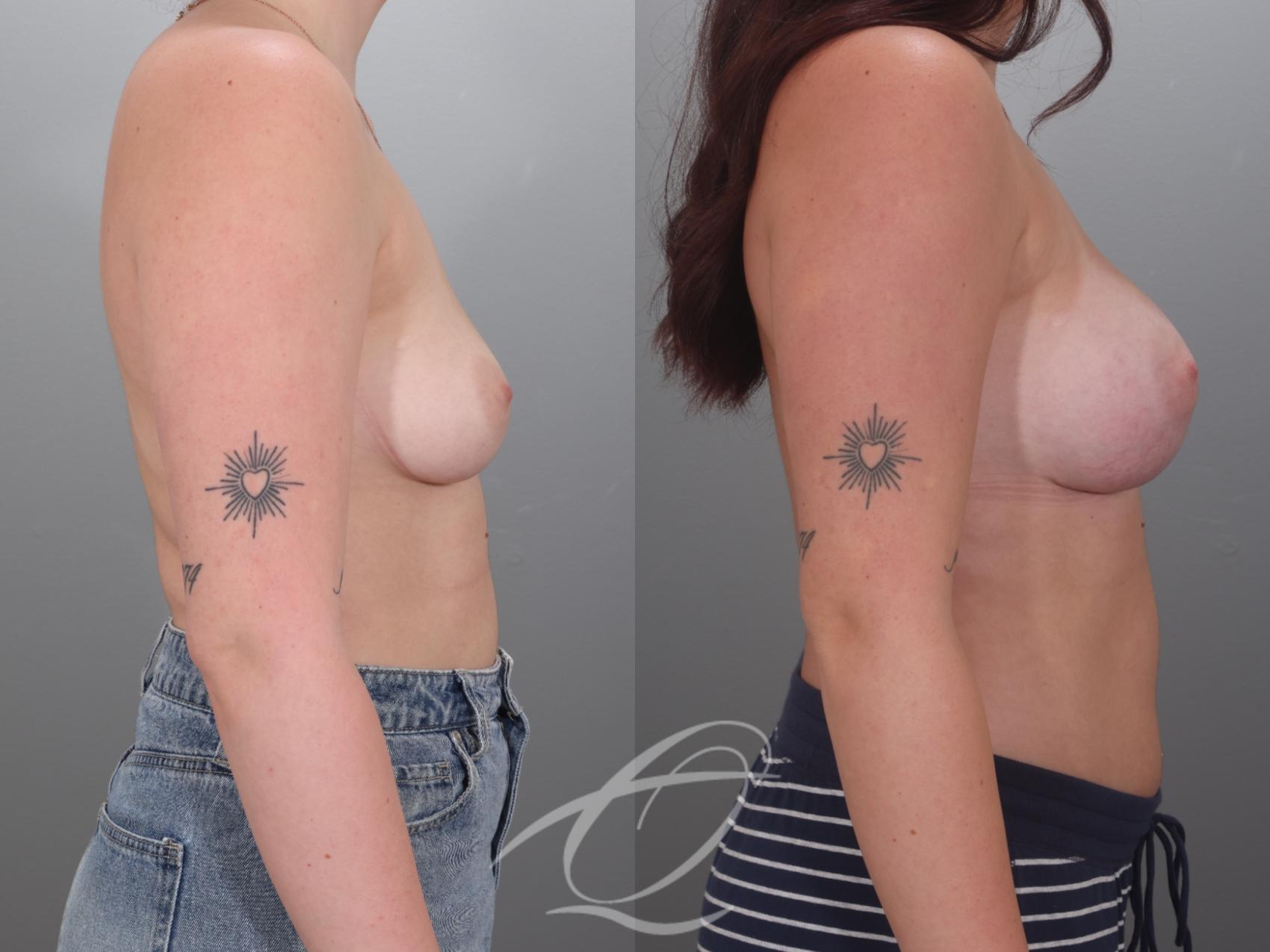 Breast Augmentation Case 1002036 Before & After Right Side | Serving Rochester, Syracuse & Buffalo, NY | Quatela Center for Plastic Surgery