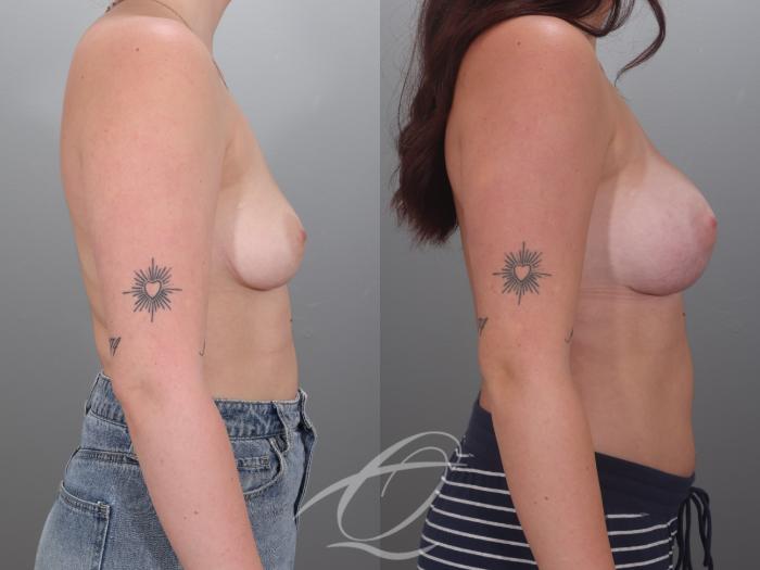 Breast Augmentation Case 1002036 Before & After Right Side | Serving Rochester, Syracuse & Buffalo, NY | Quatela Center for Plastic Surgery