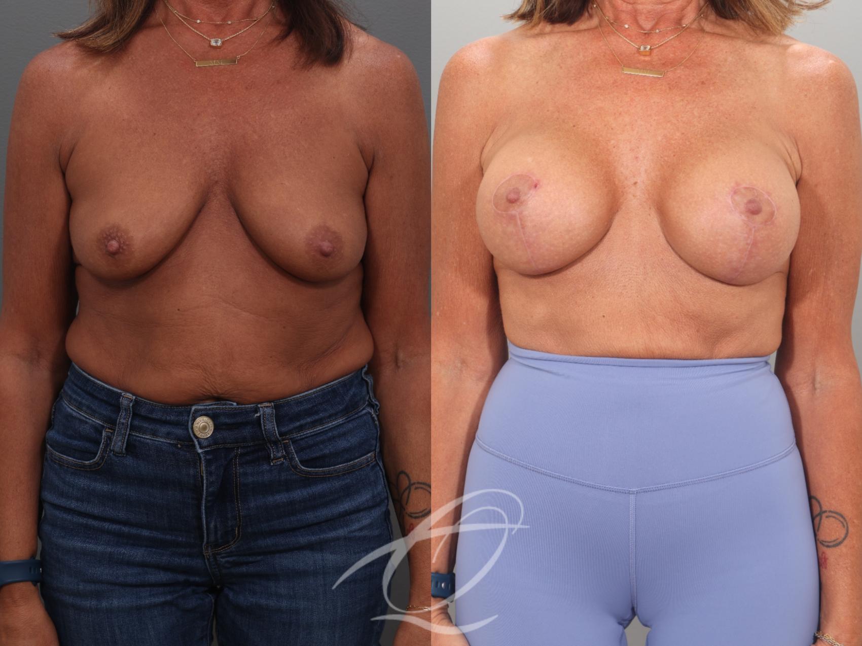 Breast Augmentation Case 1002057 Before & After Front | Serving Rochester, Syracuse & Buffalo, NY | Quatela Center for Plastic Surgery