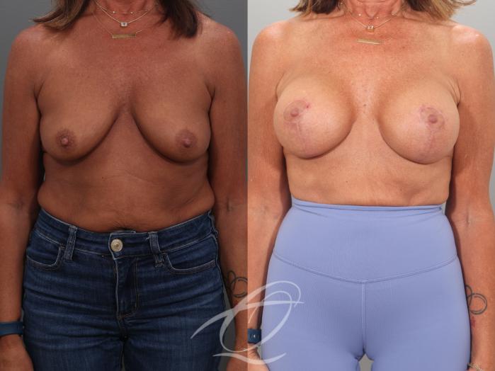 Breast Augmentation Case 1002057 Before & After Front | Serving Rochester, Syracuse & Buffalo, NY | Quatela Center for Plastic Surgery