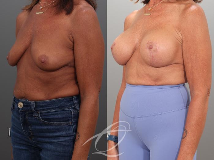Breast Augmentation Case 1002057 Before & After Left Oblique | Serving Rochester, Syracuse & Buffalo, NY | Quatela Center for Plastic Surgery