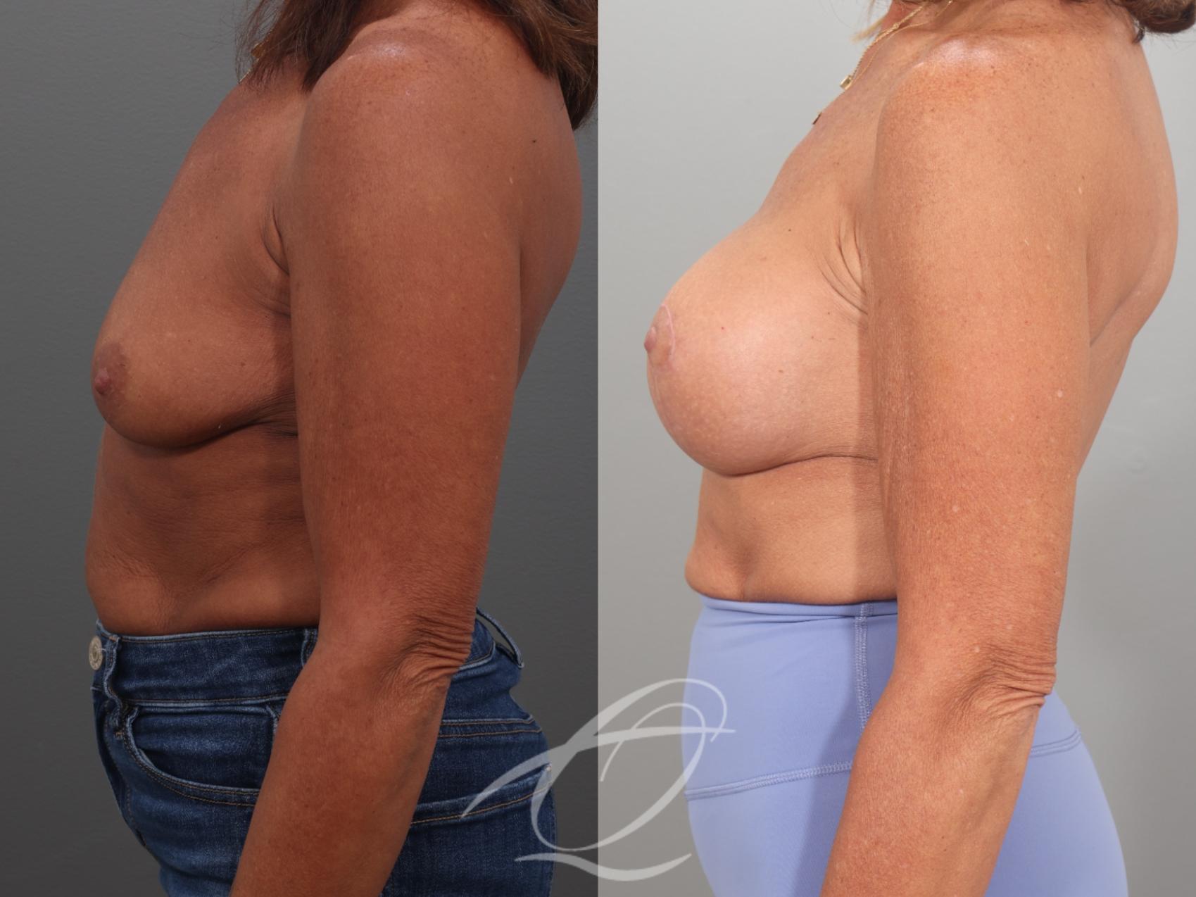 Breast Augmentation Case 1002057 Before & After Left Side | Serving Rochester, Syracuse & Buffalo, NY | Quatela Center for Plastic Surgery