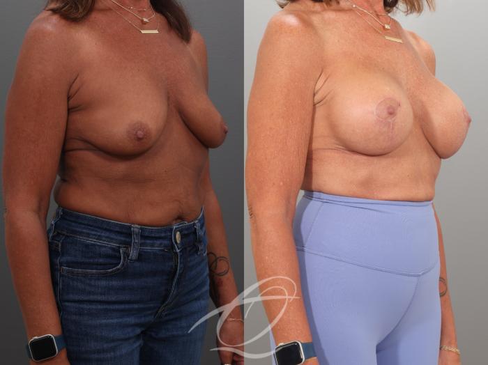 Breast Augmentation Case 1002057 Before & After Right Oblique | Serving Rochester, Syracuse & Buffalo, NY | Quatela Center for Plastic Surgery