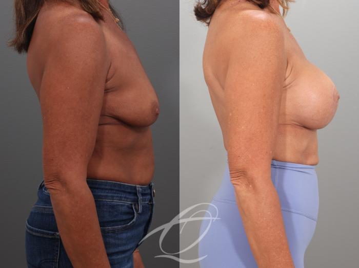 Breast Augmentation Case 1002057 Before & After Right Side | Serving Rochester, Syracuse & Buffalo, NY | Quatela Center for Plastic Surgery