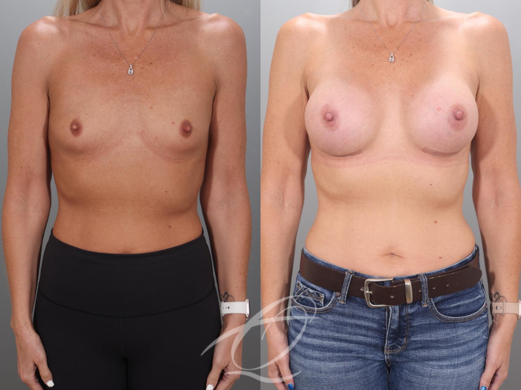 Breast Augmentation Case 1002068 Before & After Front | Serving Rochester, Syracuse & Buffalo, NY | Quatela Center for Plastic Surgery