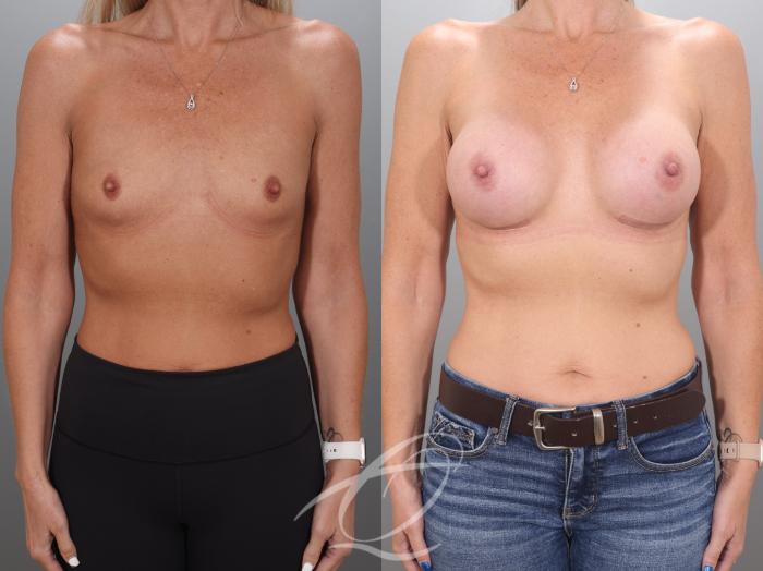 Breast Augmentation Case 1002068 Before & After Front | Serving Rochester, Syracuse & Buffalo, NY | Quatela Center for Plastic Surgery