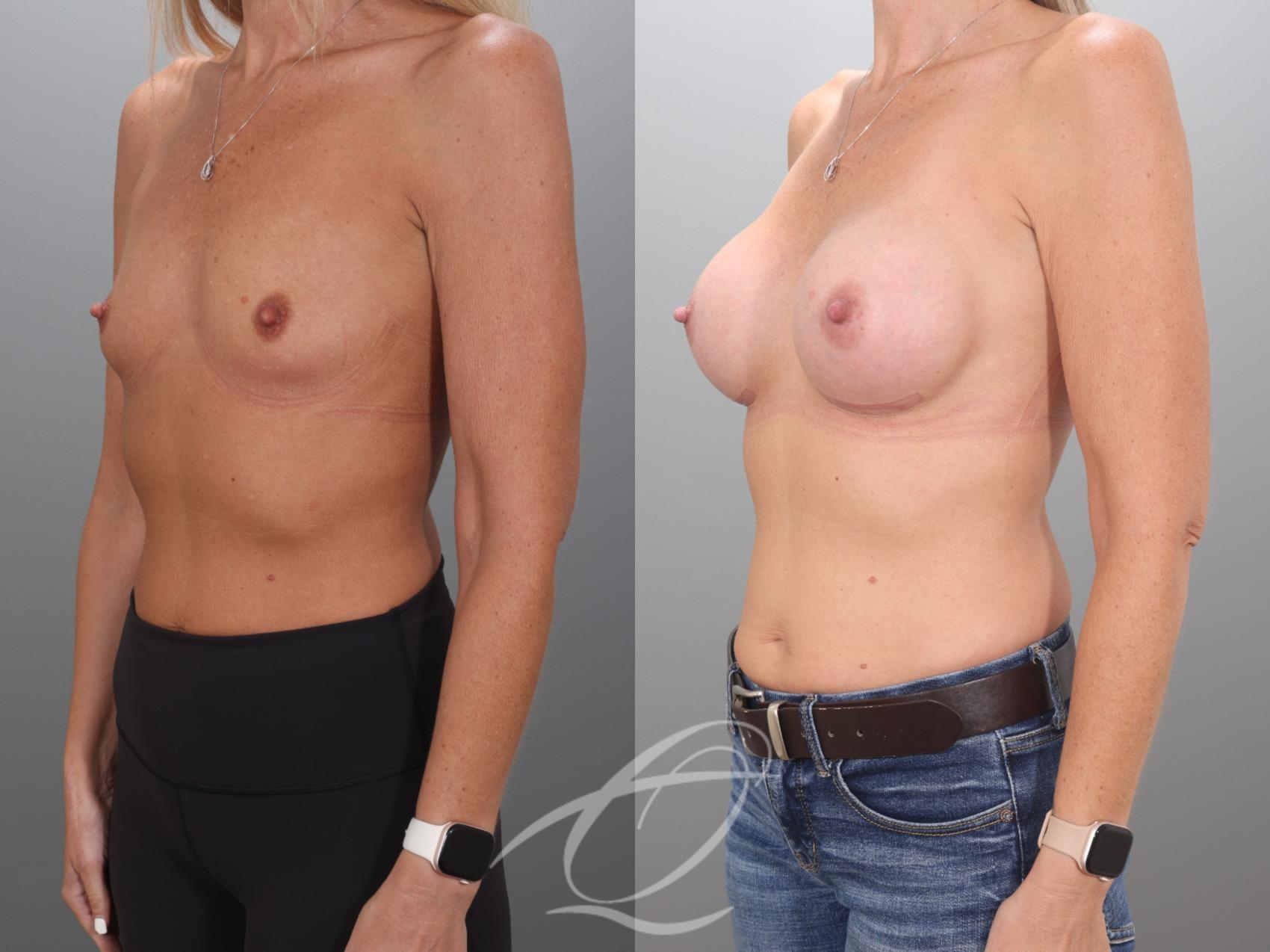 Breast Augmentation Case 1002068 Before & After Left Oblique | Serving Rochester, Syracuse & Buffalo, NY | Quatela Center for Plastic Surgery