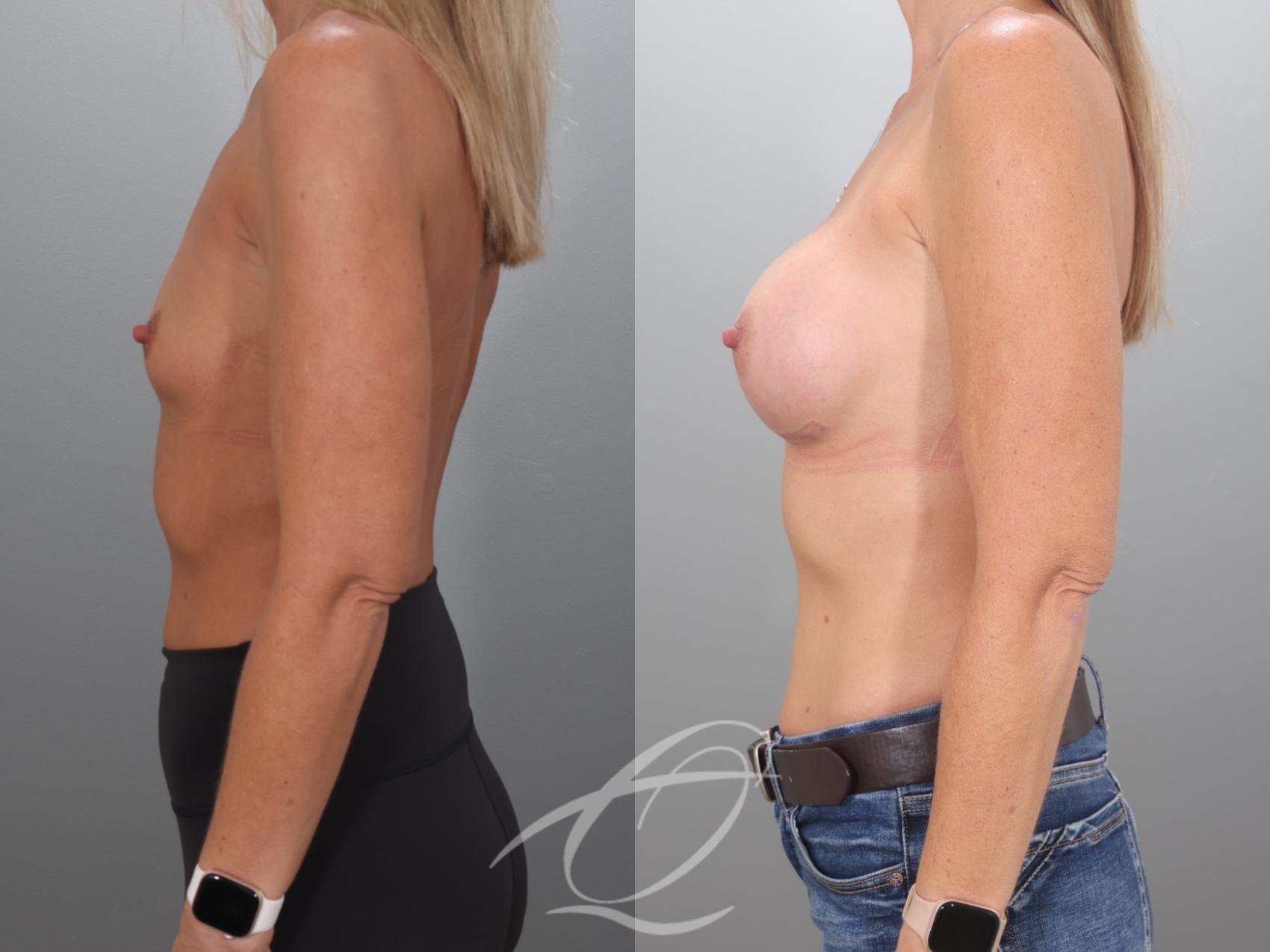 Breast Augmentation Case 1002068 Before & After Left Side | Serving Rochester, Syracuse & Buffalo, NY | Quatela Center for Plastic Surgery