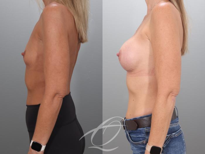 Breast Augmentation Case 1002068 Before & After Left Side | Serving Rochester, Syracuse & Buffalo, NY | Quatela Center for Plastic Surgery