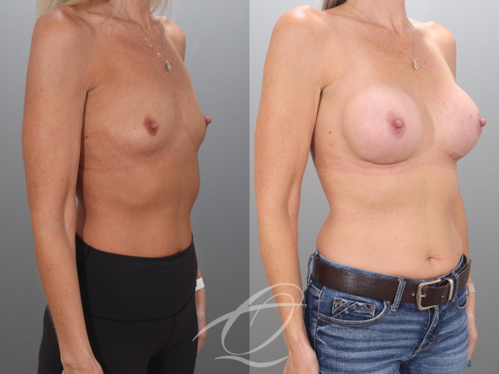 Breast Augmentation Case 1002068 Before & After Right Oblique | Serving Rochester, Syracuse & Buffalo, NY | Quatela Center for Plastic Surgery