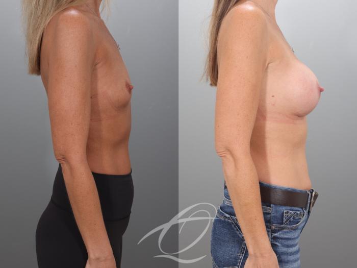 Breast Augmentation Case 1002068 Before & After Right Side | Serving Rochester, Syracuse & Buffalo, NY | Quatela Center for Plastic Surgery