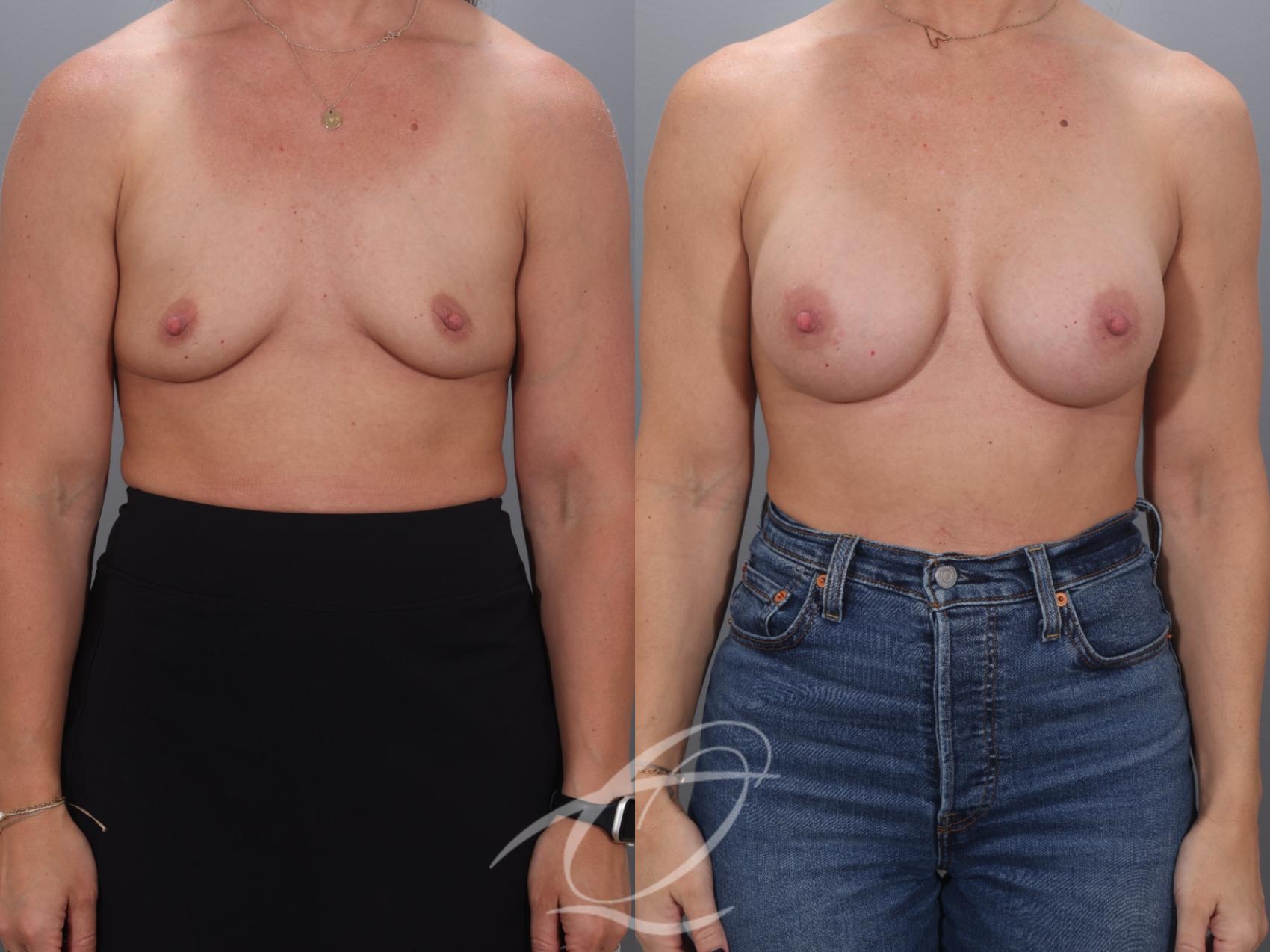 Breast Augmentation Case 1002071 Before & After Front | Serving Rochester, Syracuse & Buffalo, NY | Quatela Center for Plastic Surgery