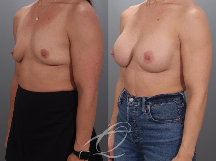 Breast Augmentation Case 1002071 Before & After Left Oblique | Serving Rochester, Syracuse & Buffalo, NY | Quatela Center for Plastic Surgery