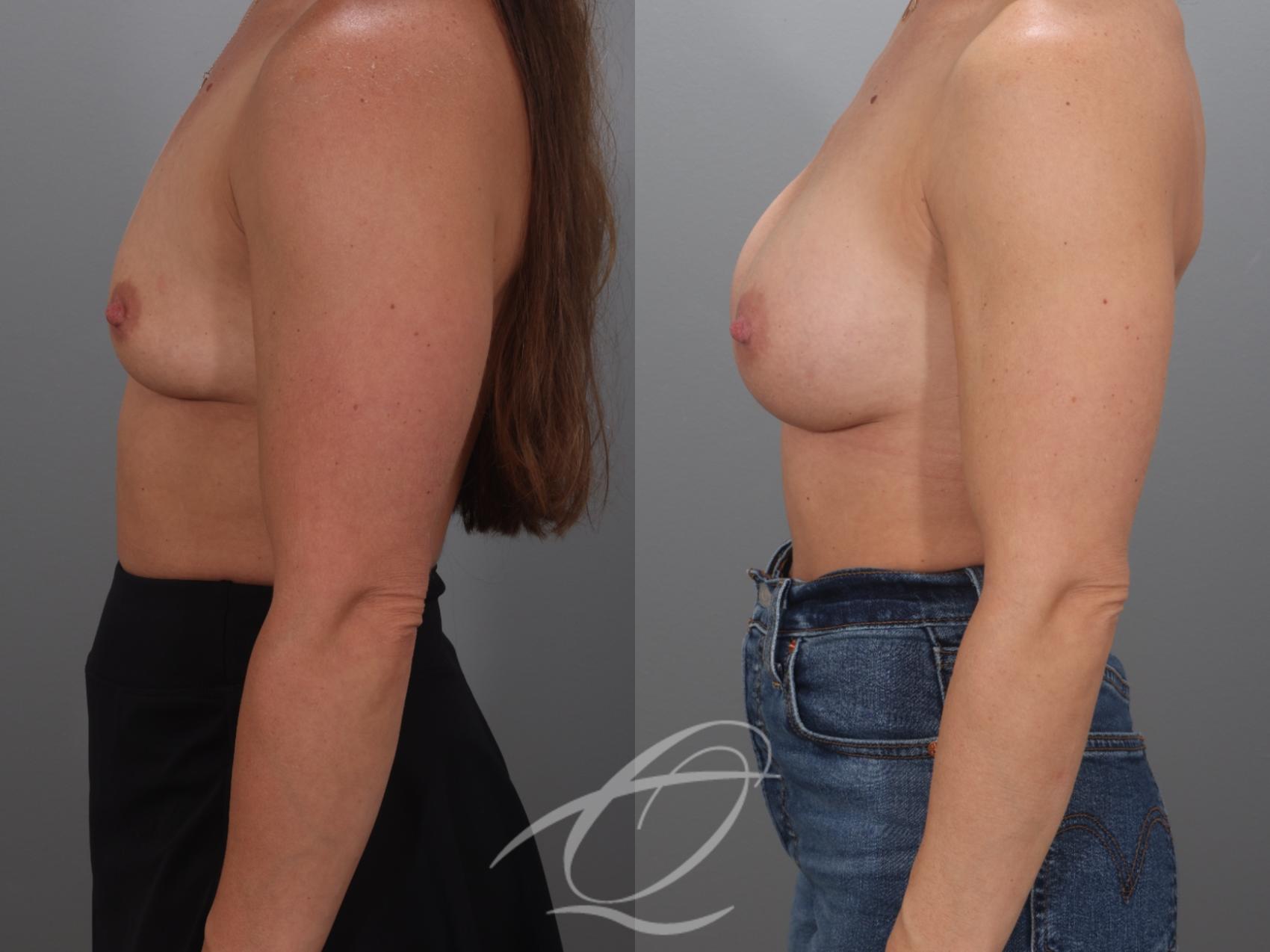 Breast Augmentation Case 1002071 Before & After Left Side | Serving Rochester, Syracuse & Buffalo, NY | Quatela Center for Plastic Surgery