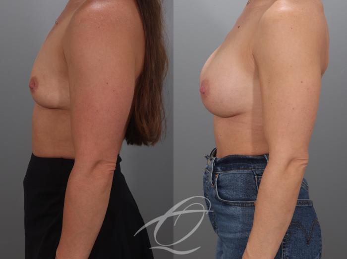 Breast Augmentation Case 1002071 Before & After Left Side | Serving Rochester, Syracuse & Buffalo, NY | Quatela Center for Plastic Surgery