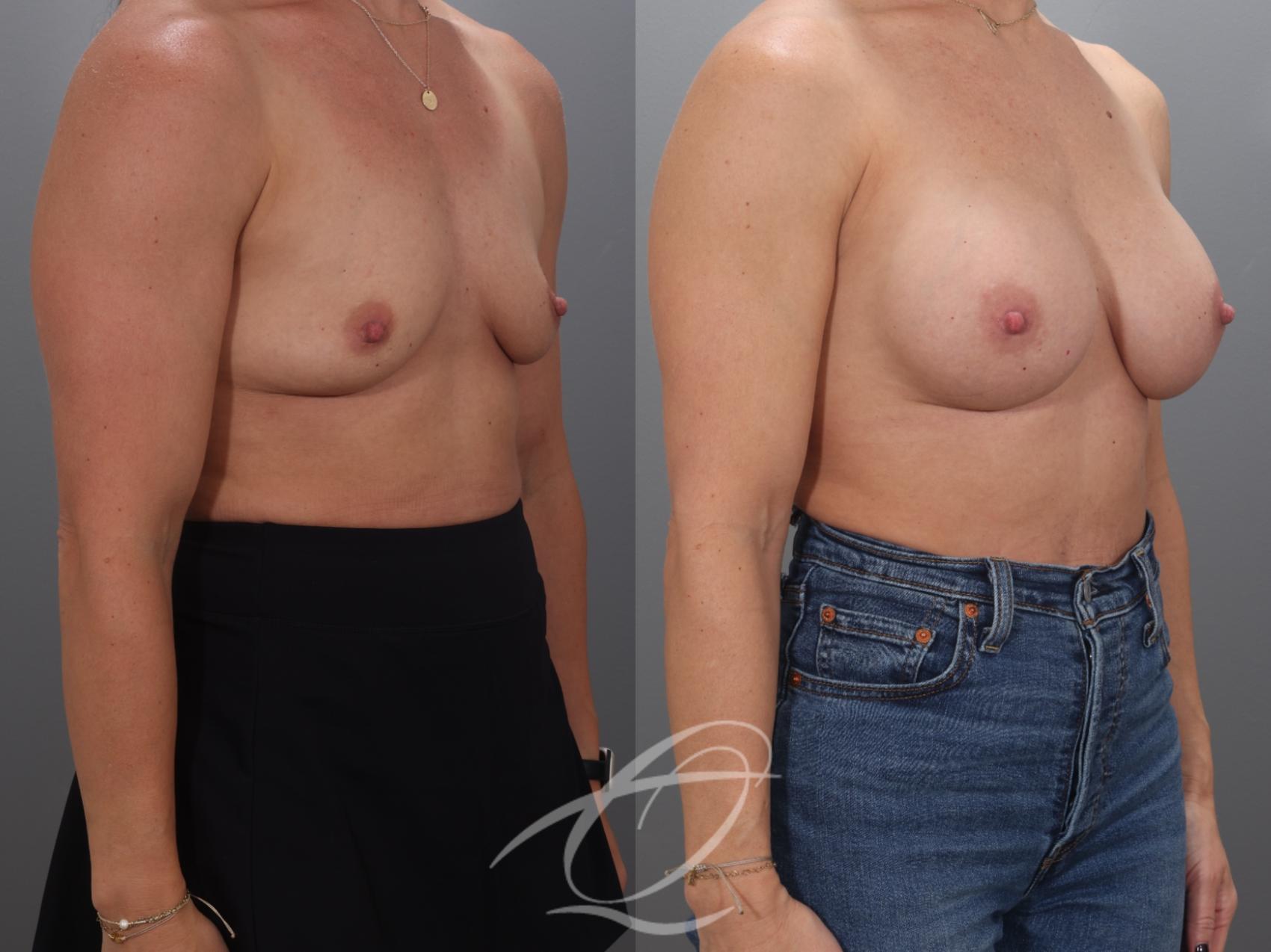 Breast Augmentation Case 1002071 Before & After Right Oblique | Serving Rochester, Syracuse & Buffalo, NY | Quatela Center for Plastic Surgery