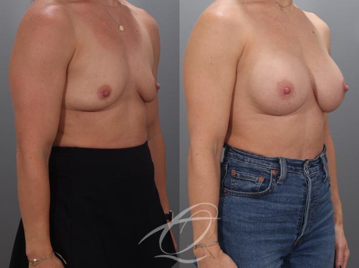Breast Augmentation Case 1002071 Before & After Right Oblique | Serving Rochester, Syracuse & Buffalo, NY | Quatela Center for Plastic Surgery