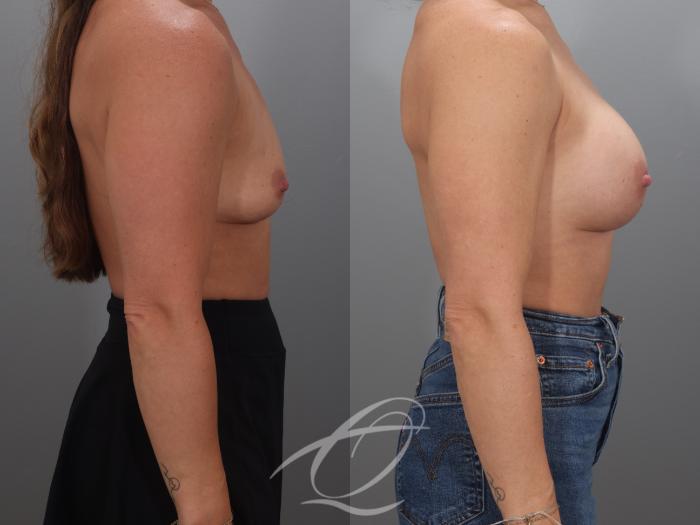 Breast Augmentation Case 1002071 Before & After Right Side | Serving Rochester, Syracuse & Buffalo, NY | Quatela Center for Plastic Surgery