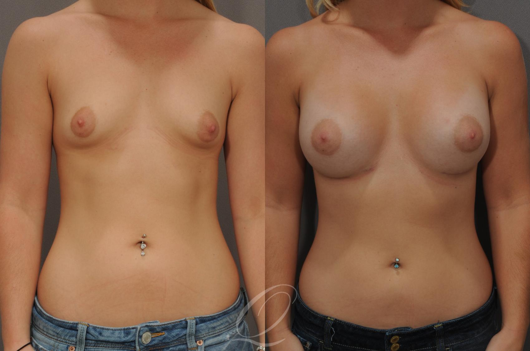 Breast Augmentation Case 101 Before & After View #1 | Serving Rochester, Syracuse & Buffalo, NY | Quatela Center for Plastic Surgery