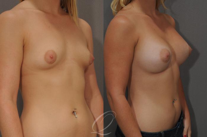 Breast Augmentation Case 101 Before & After View #2 | Serving Rochester, Syracuse & Buffalo, NY | Quatela Center for Plastic Surgery