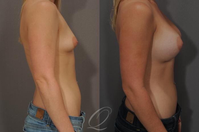 Breast Augmentation Case 101 Before & After View #3 | Serving Rochester, Syracuse & Buffalo, NY | Quatela Center for Plastic Surgery