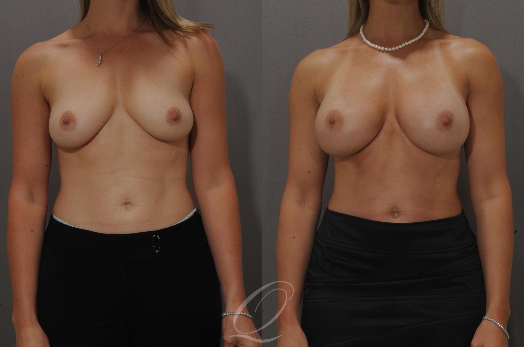 Breast Augmentation Case 102 Before & After View #1 | Serving Rochester, Syracuse & Buffalo, NY | Quatela Center for Plastic Surgery