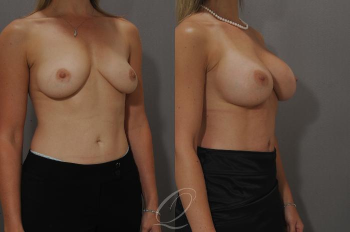 Breast Augmentation Case 102 Before & After View #2 | Serving Rochester, Syracuse & Buffalo, NY | Quatela Center for Plastic Surgery