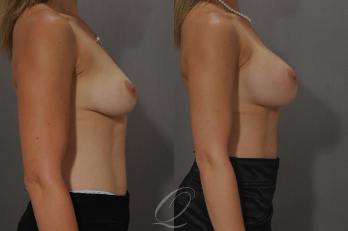 Breast Augmentation Case 102 Before & After View #3 | Serving Rochester, Syracuse & Buffalo, NY | Quatela Center for Plastic Surgery