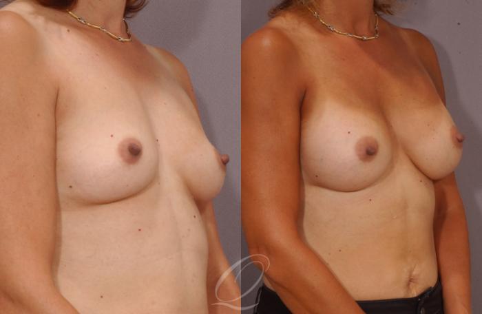 Breast Augmentation Case 1058 Before & After View #2 | Serving Rochester, Syracuse & Buffalo, NY | Quatela Center for Plastic Surgery