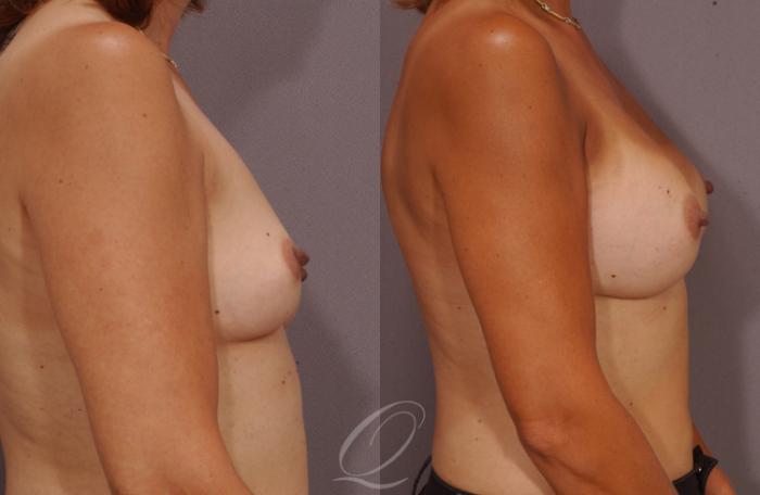 Breast Augmentation Case 1058 Before & After View #3 | Serving Rochester, Syracuse & Buffalo, NY | Quatela Center for Plastic Surgery