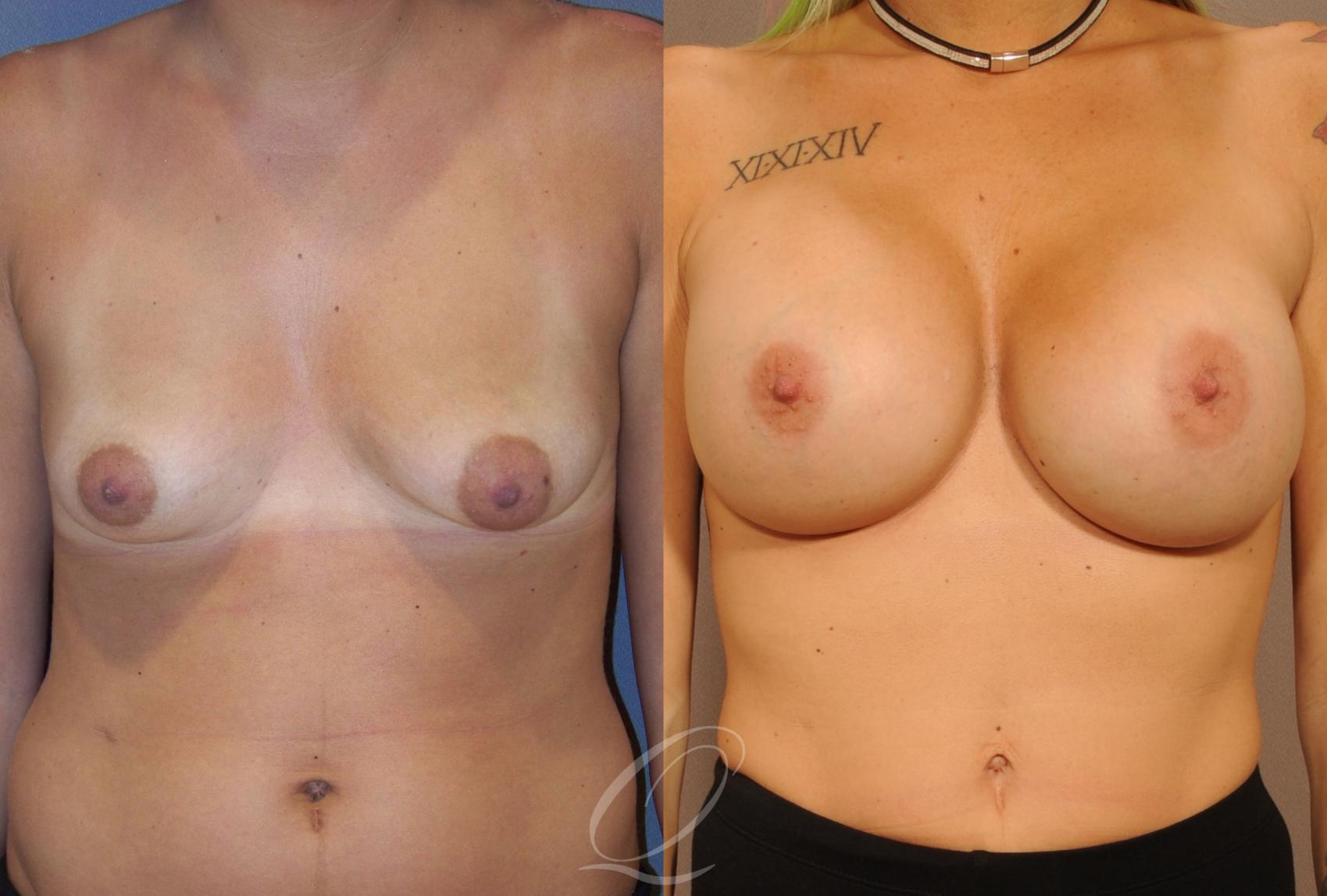 Breast Augmentation Case 1059 Before & After View #1 | Serving Rochester, Syracuse & Buffalo, NY | Quatela Center for Plastic Surgery