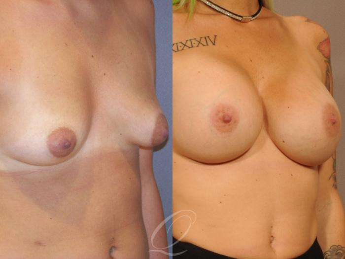 Breast Augmentation Case 1059 Before & After View #2 | Serving Rochester, Syracuse & Buffalo, NY | Quatela Center for Plastic Surgery