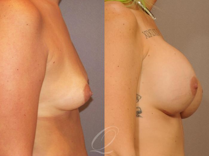 Breast Augmentation Case 1059 Before & After View #3 | Serving Rochester, Syracuse & Buffalo, NY | Quatela Center for Plastic Surgery