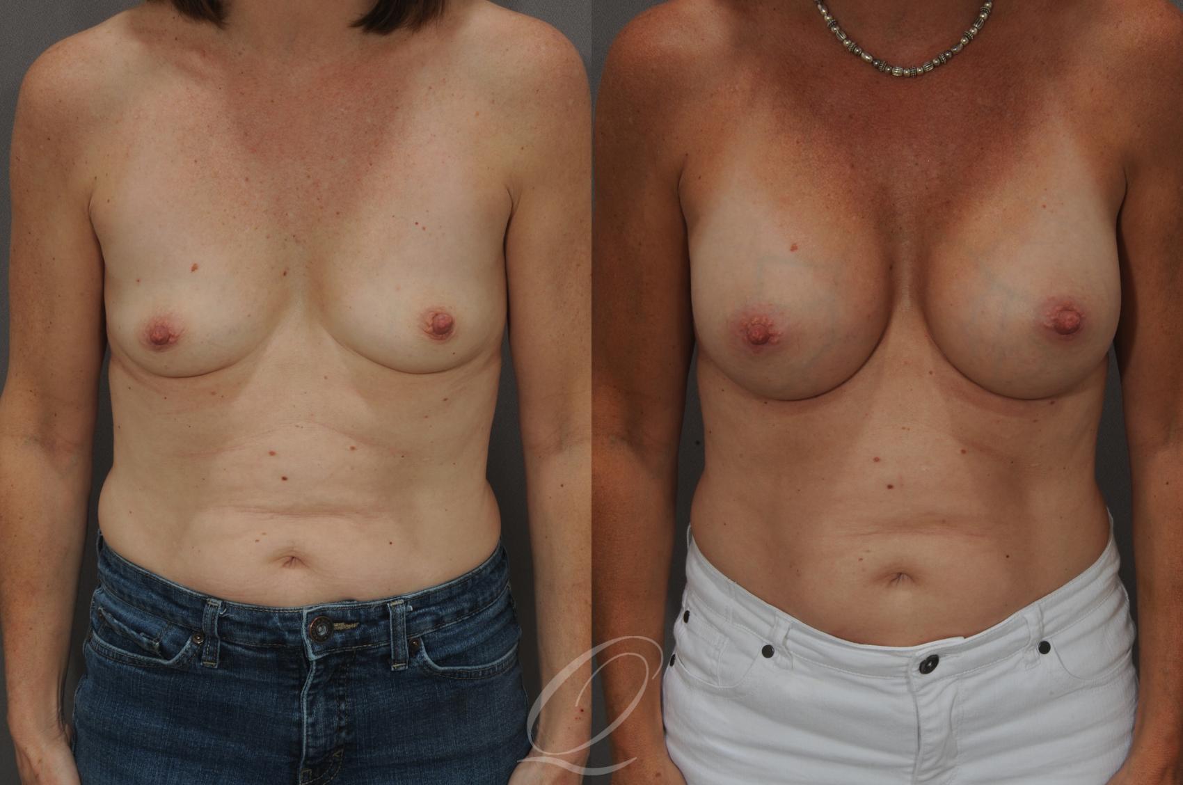 Breast Augmentation Case 1060 Before & After View #1 | Serving Rochester, Syracuse & Buffalo, NY | Quatela Center for Plastic Surgery
