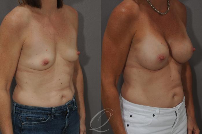 Breast Augmentation Case 1060 Before & After View #2 | Serving Rochester, Syracuse & Buffalo, NY | Quatela Center for Plastic Surgery