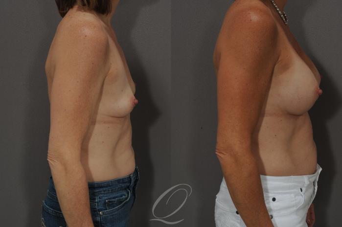 Breast Augmentation Case 1060 Before & After View #3 | Serving Rochester, Syracuse & Buffalo, NY | Quatela Center for Plastic Surgery