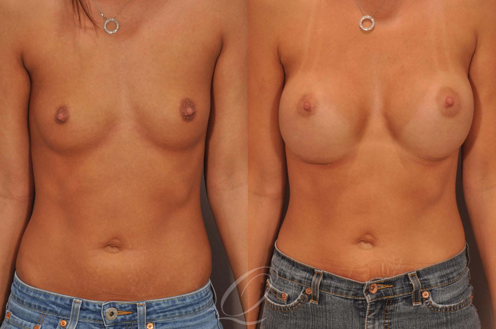Breast Augmentation Case 1068 Before & After View #1 | Serving Rochester, Syracuse & Buffalo, NY | Quatela Center for Plastic Surgery