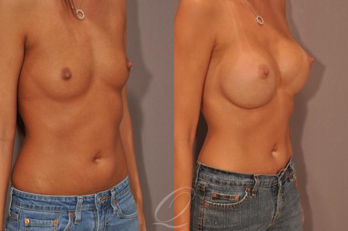 Breast Augmentation Case 1068 Before & After View #2 | Serving Rochester, Syracuse & Buffalo, NY | Quatela Center for Plastic Surgery