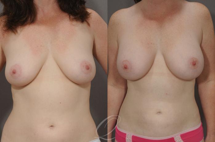 Breast Augmentation Case 1070 Before & After View #1 | Serving Rochester, Syracuse & Buffalo, NY | Quatela Center for Plastic Surgery